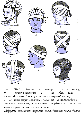 Повязки на голову и шею. Наложение повязки при черепно-мозговой травме. Бинтовая повязка на голову. Повязки на голову бинтовая название. Повязка на голову при травме.